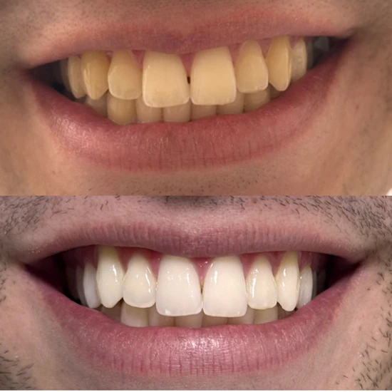 Antes e depois de clareamento dental